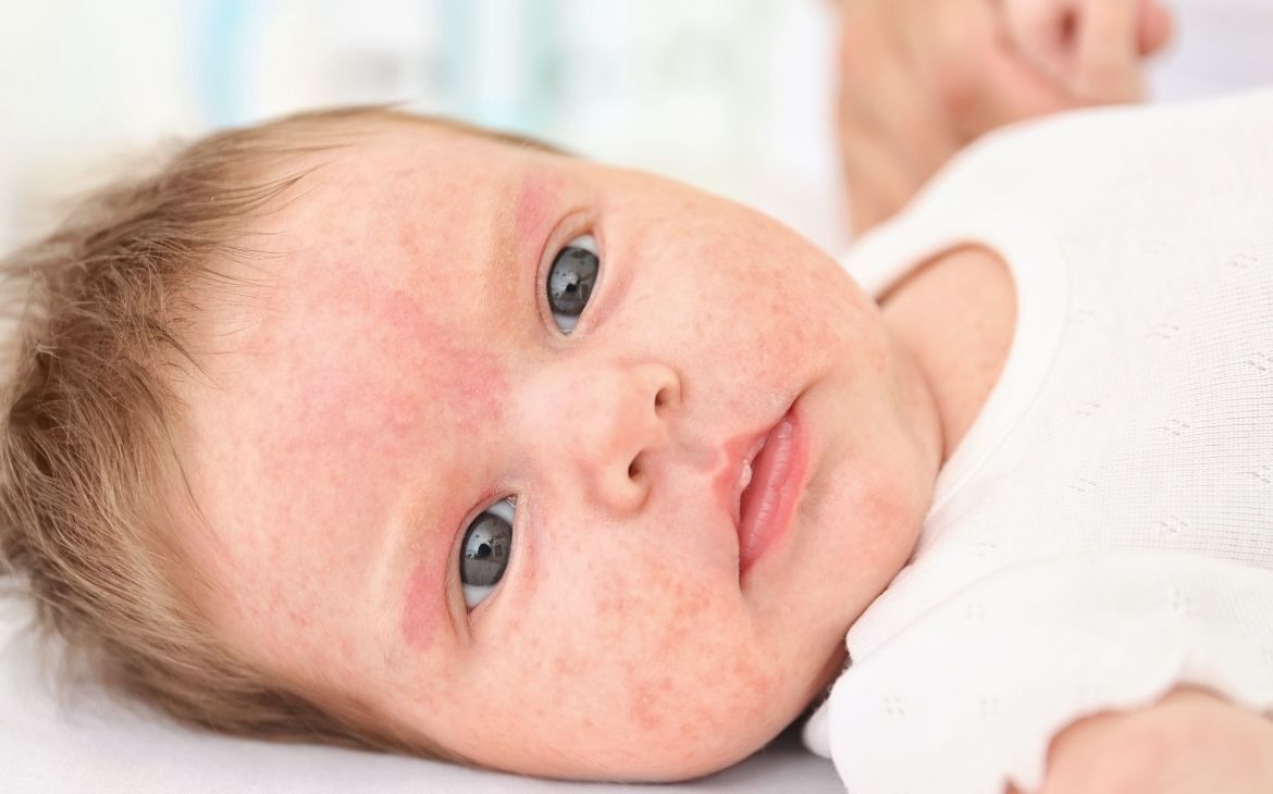 Alergia ao calor na pele do bebê