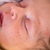 Acne neonatal: o que é, como identificar e tratar