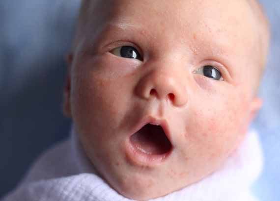 Acne neonatal em bebês