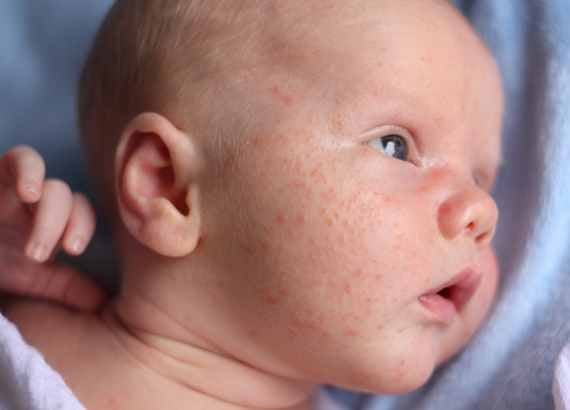 Acne neonatal em bebês